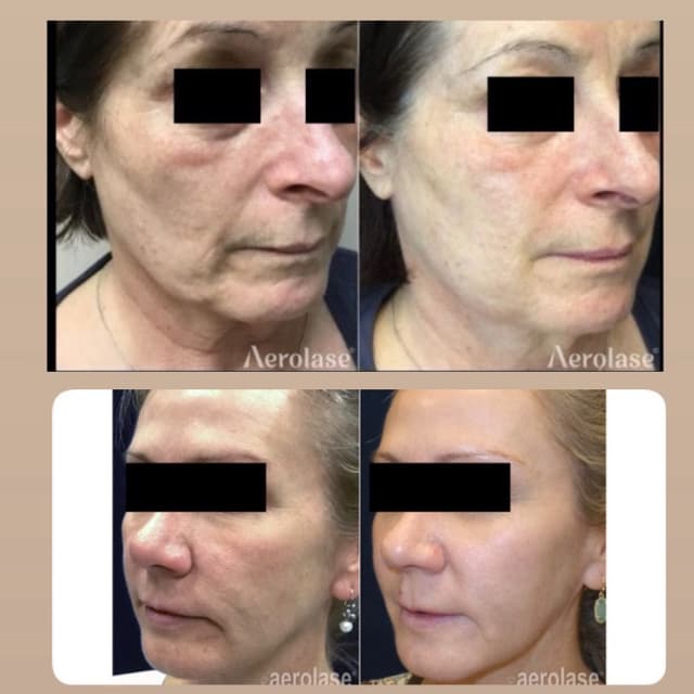 Aerolase Neo Rejuvenation Package at Soul Aura in Indian Orchard, MA
